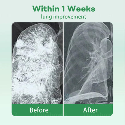 ✅Official Store| Cvreoz® Herbal Lung Cleansing Inhaier(🫁Cough, wheezing, shortness of breath, sputum, stuffy nose, bronchitis, bronchitis, allergy symptoms, lung discomfort💝)